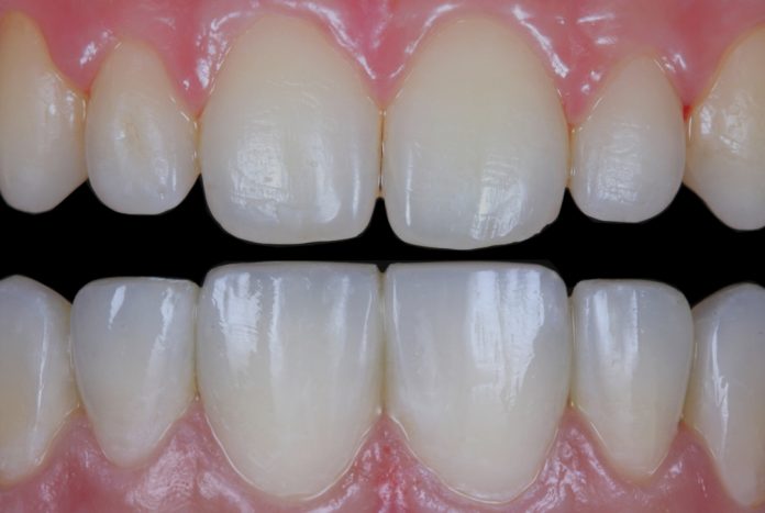 Anterior composite veneering. A minimally invasive approach to enhance the aesthetics.