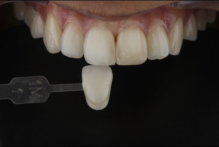 Whitening and direct composites: right choice for a bright smile